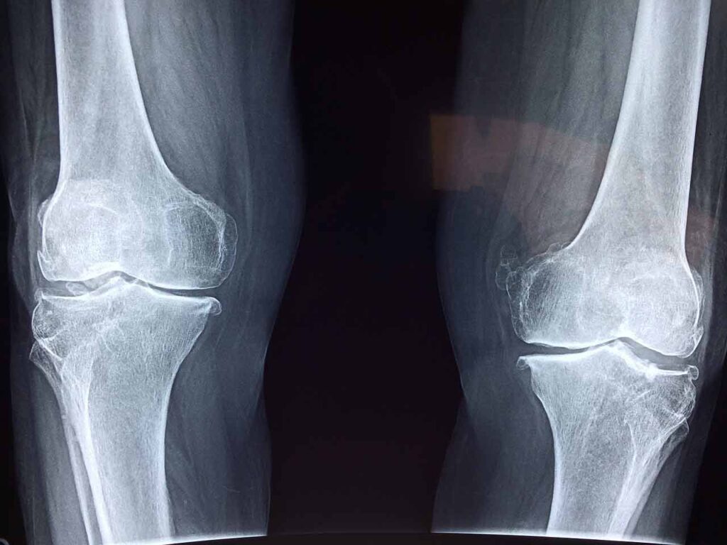 5 Most Common Car Accident Injuries 2 knee x ray image 5 common car accident injuries rimland