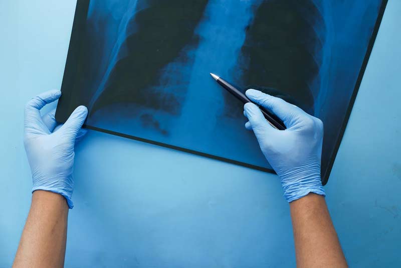 x-ray-after-a-personal-injury-new-york-rimland-law